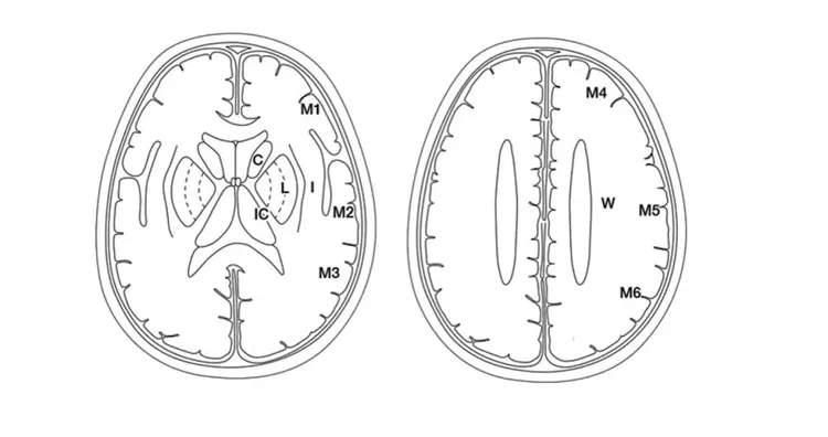 ASPECTS / DWI-ASPECTS 評価領域(基底核レベル:C, L, IC, I, M1-M3 / 半卵円中心レベル:M4-M6, W)
